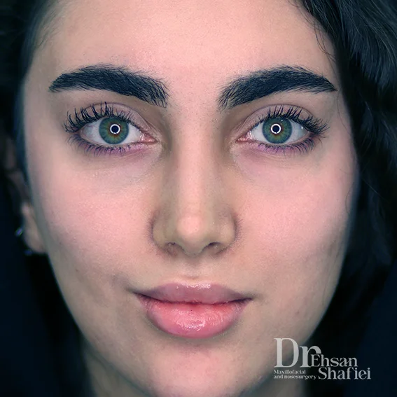 تفاوت بینی طبیعی و استخوانی