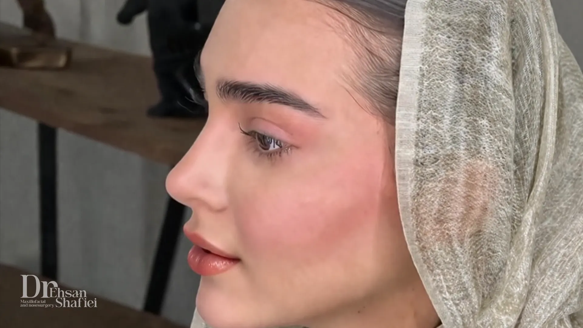 نتیجه‌ی طبیعی بینی گوشتی شش ماه پس از جراحی بینی توسط دکتر احسان شفیعی