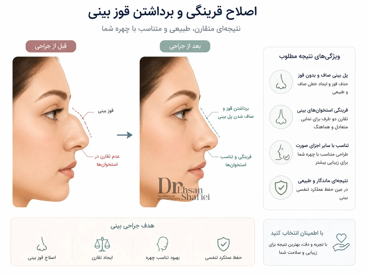 چطور قوز بینی استخوانی بدون کج شدن برداشته می‌شود؟